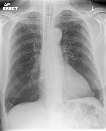 Nasogastric tube placement - correct | Radiology Case | Radiopaedia.org