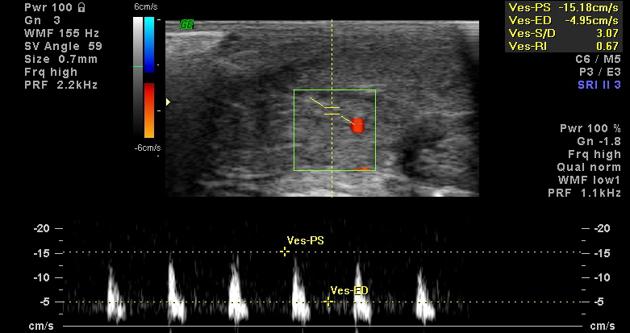 Erectile dysfunction Radiology Reference Article Radiopaedia