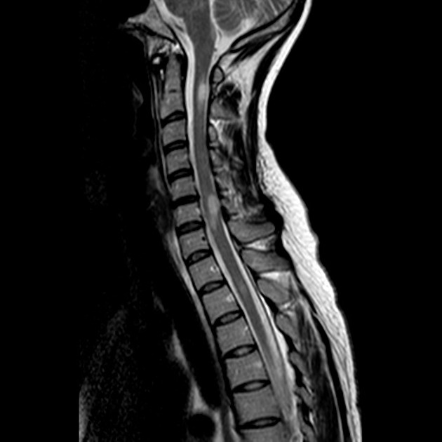 31+ Multiple Sclerosis Mri Lumbar Spine PNG