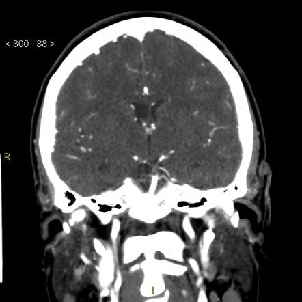 Acute basilar artery occlusion | Radiology Reference Article ...