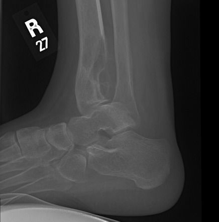 Giant cell tumor - distal tibia | Radiology Case | Radiopaedia.org