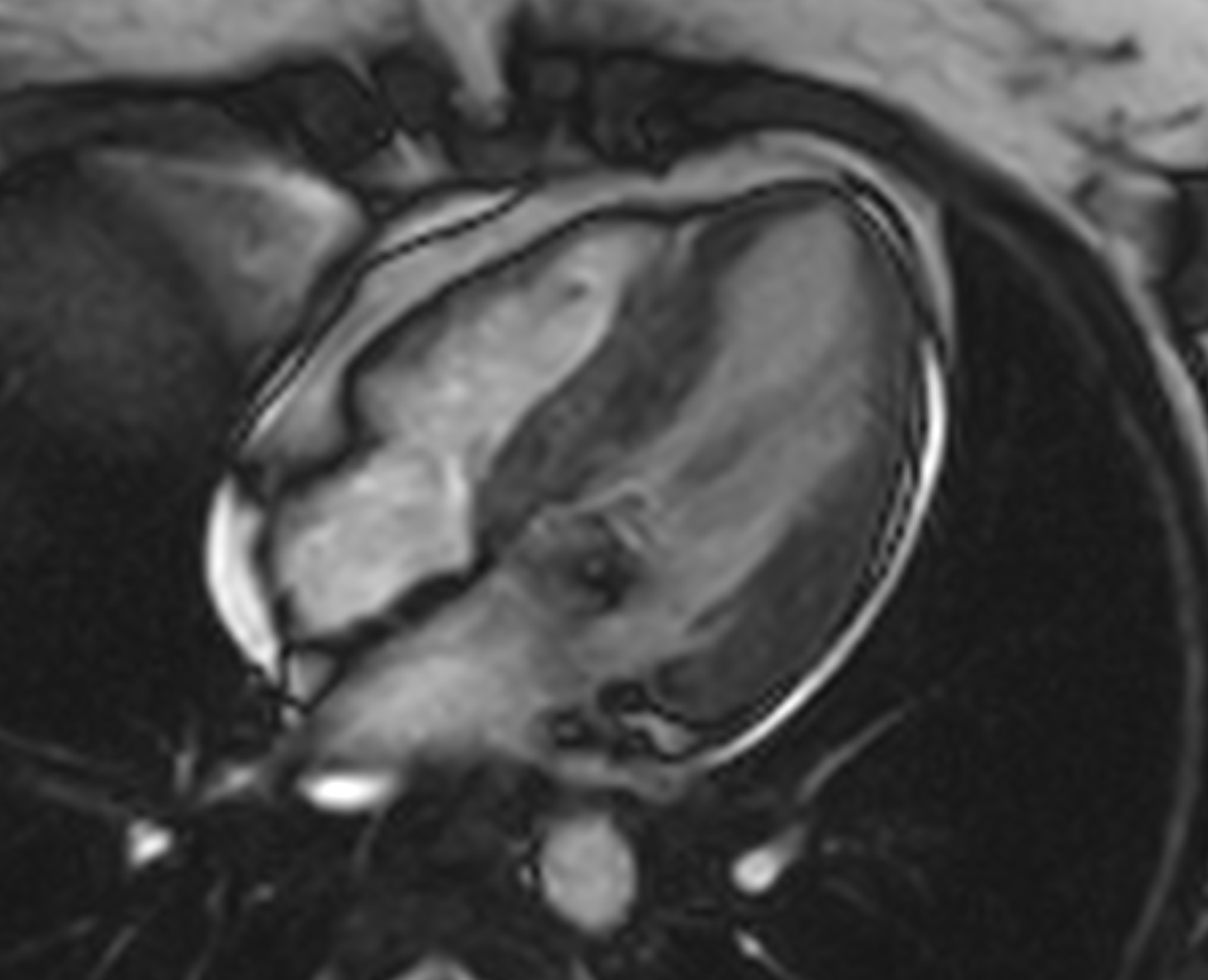 Myocarditis | Image | Radiopaedia.org