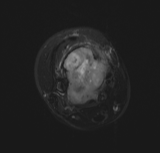 Giant cell tumor - distal tibia | Image | Radiopaedia.org