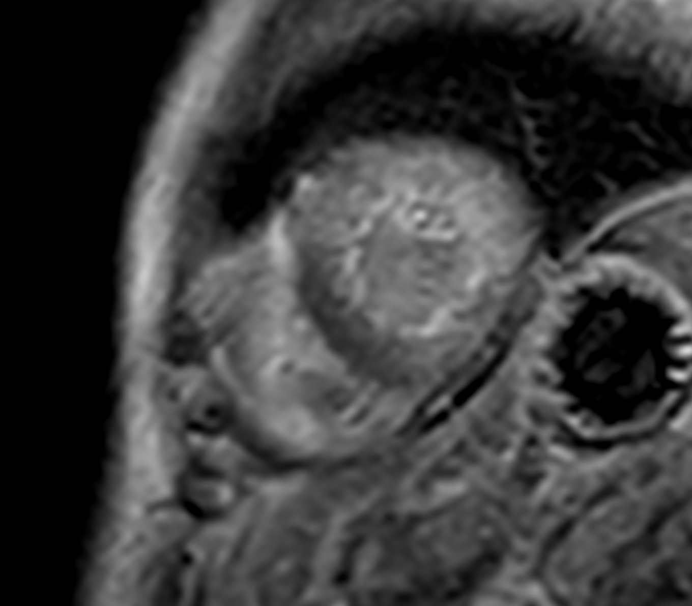 Systemic Amyloidosis Clinically Evident Mucocutaneous