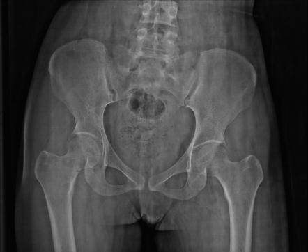 Osteomalacia Basic Science Orthobullets