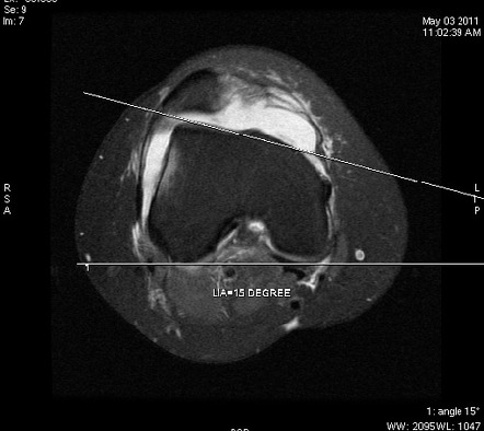 Patellofemoral instability | Radiology Reference Article | Radiopaedia.org