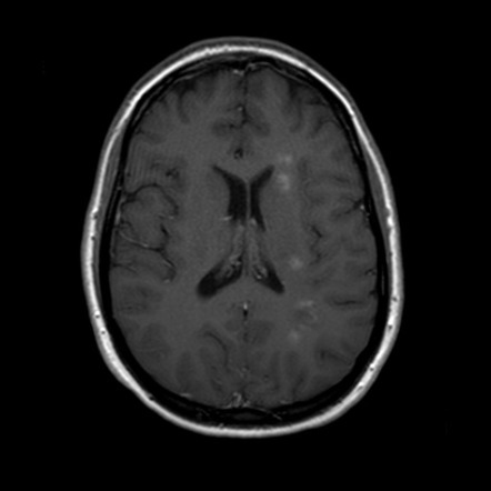 Demyelination | Image | Radiopaedia.org