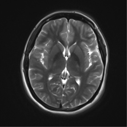 Moyamoya: superficial temporal artery to middle cerebral artery bypass ...