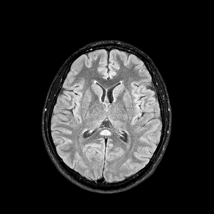 Cytotoxic lesions of the corpus callosum (CLOCCs) | Radiology Reference ...