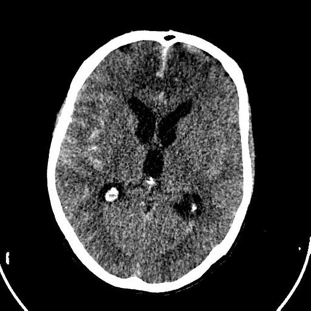 Anterior Cerebral Artery Stroke