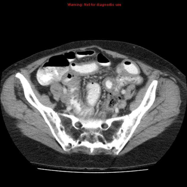 Radiation induced enteritis Radiology Reference Article