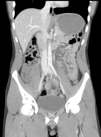 Traumatic bowel and abdominal aortic injuries | Radiology Case ...