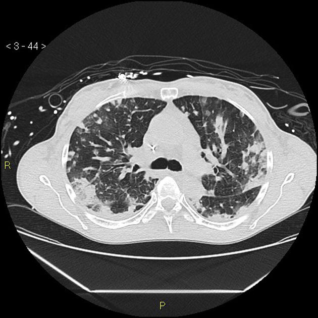 Acute Respiratory Distress Syndrome - FRCEM Secrets