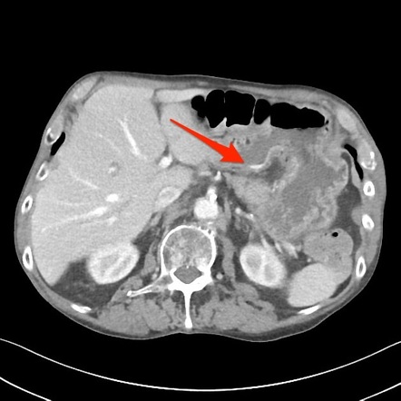 Upper gastrointestinal bleeding - gastric ulcer | Image | Radiopaedia.org