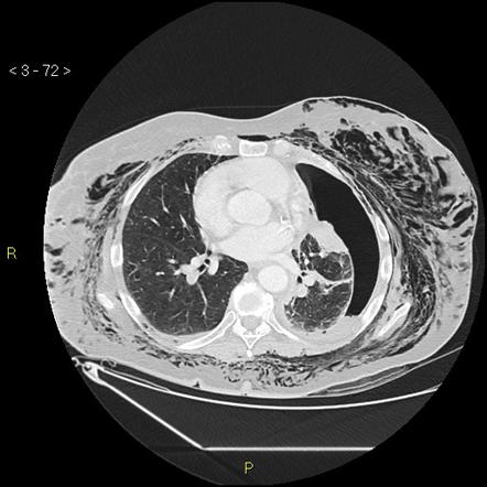 Subcutaneous emphysema | Radiology Reference Article | Radiopaedia.org