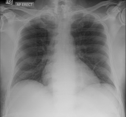 Pneumoperitoneum from perforated diverticulitis | Radiology Case ...