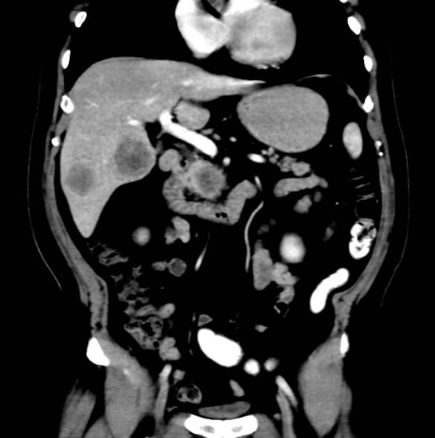 Pancreatic Ductal Adenocarcinoma | Image | Radiopaedia.org