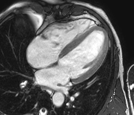 Physiological cardiac adaptation to exercise | Radiology Case ...