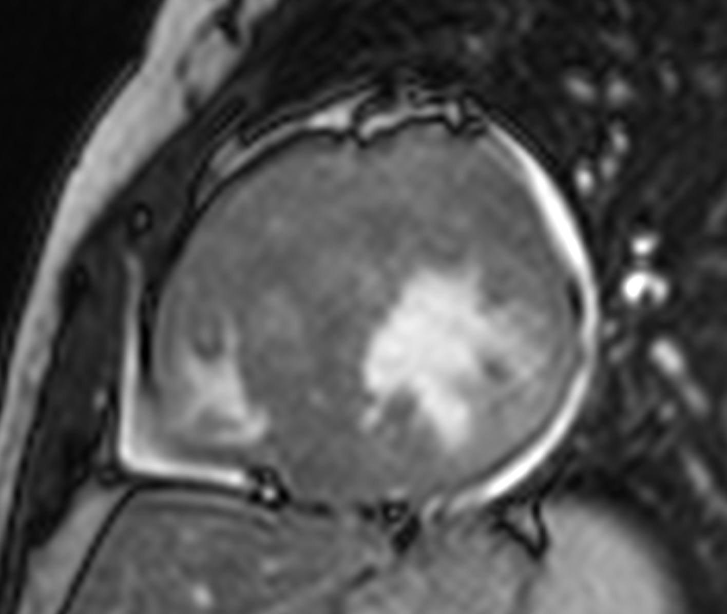 Hypertrophic Cardiomyopathy Severe Image 7395