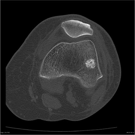 Enchondroma - distal femur | Image | Radiopaedia.org