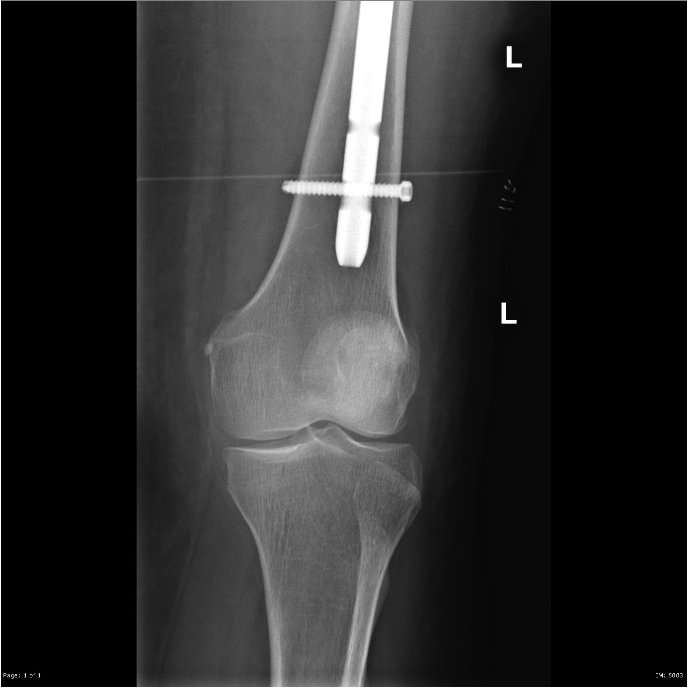 Enchondroma - distal femur | Image | Radiopaedia.org