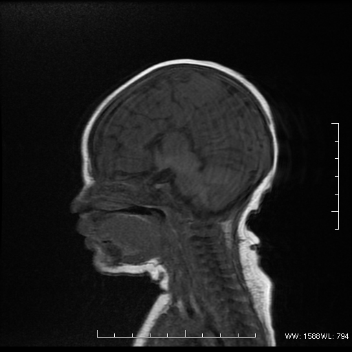 Agenesis Of The Corpus Callosum Image