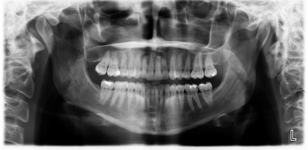 Odontogenic keratocyst | Radiology Reference Article | Radiopaedia.org