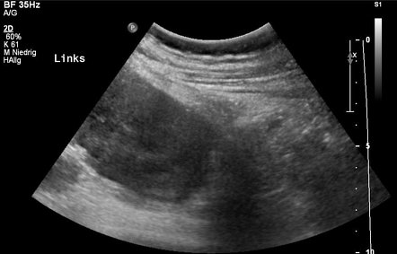 Juvenile malignant melanoma | Radiology Case | Radiopaedia.org