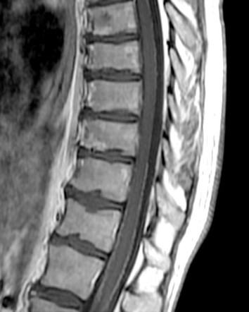 Intradural Extramedullary Metastases Radiology Reference Article