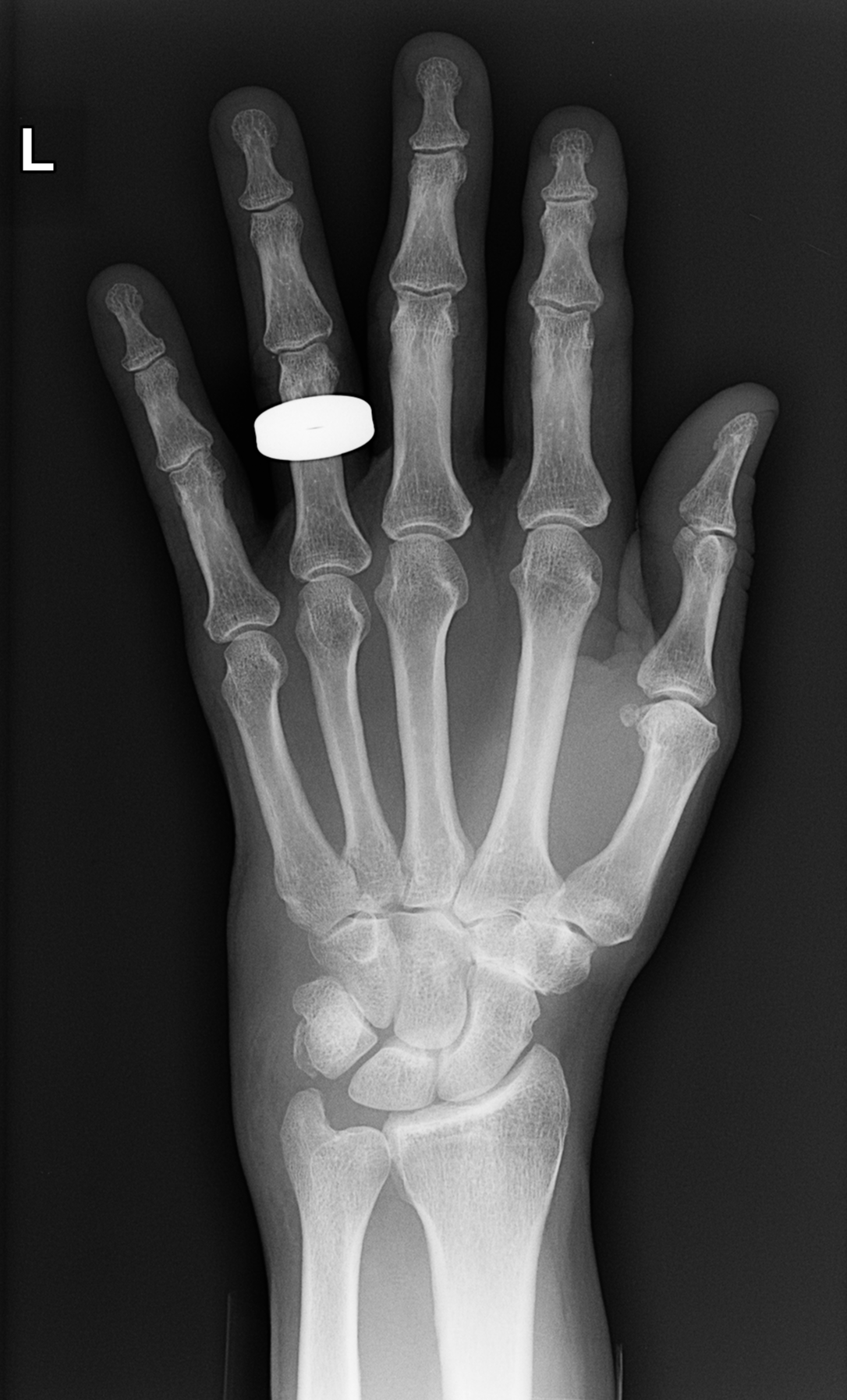 File:Fracture triquetrum, ulnar styloid and index finger distal phalanx ...