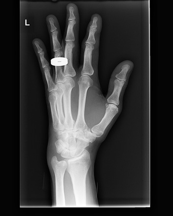 open fracture of tuft of distal phalanx icd 10