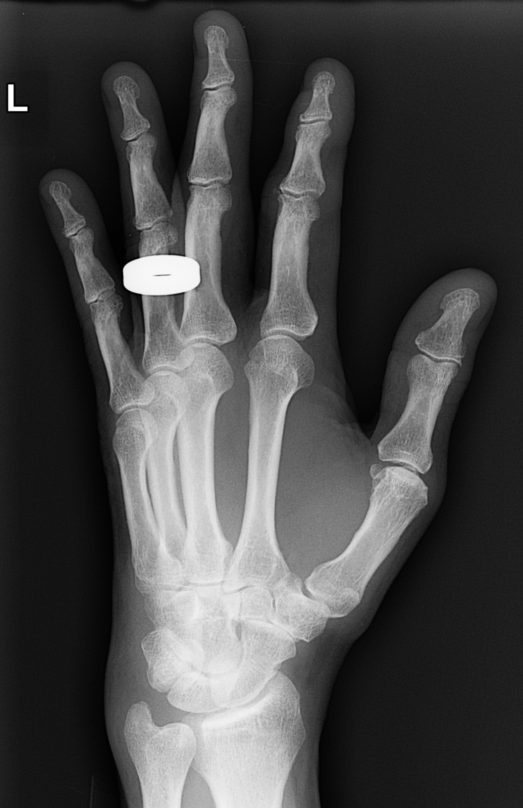 File:Fracture triquetrum, ulnar styloid and index finger distal phalanx ...