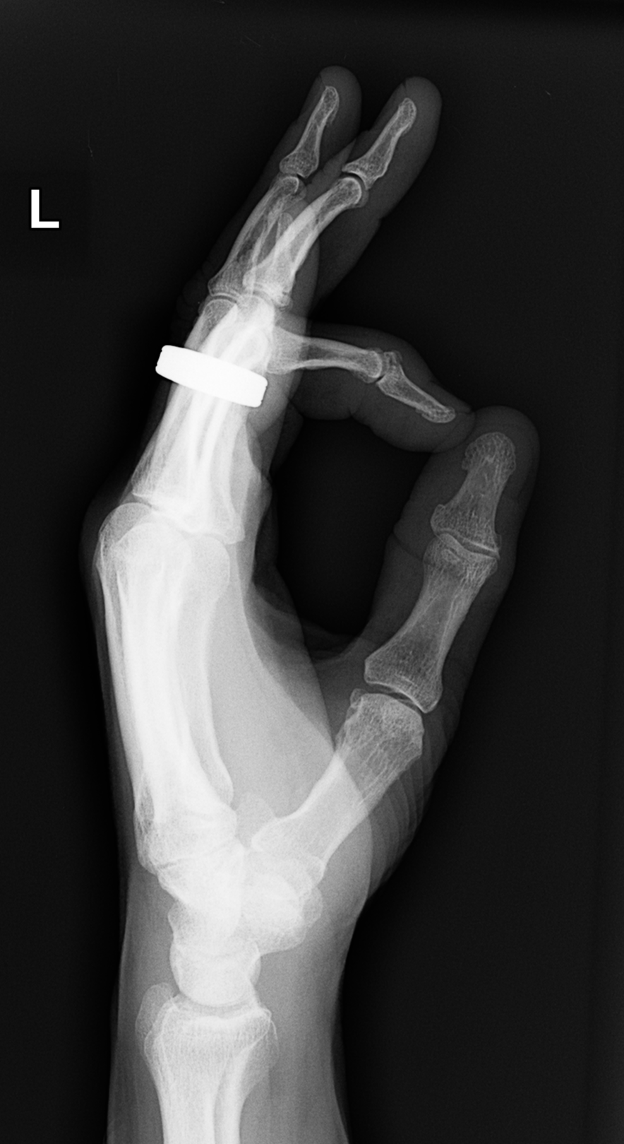 File:Fracture triquetrum, ulnar styloid and index finger distal phalanx ...