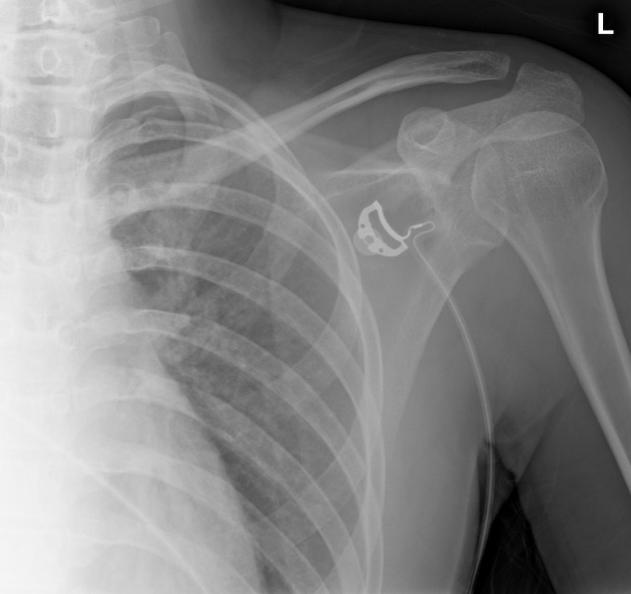 Pneumothorax on shoulder xray Image