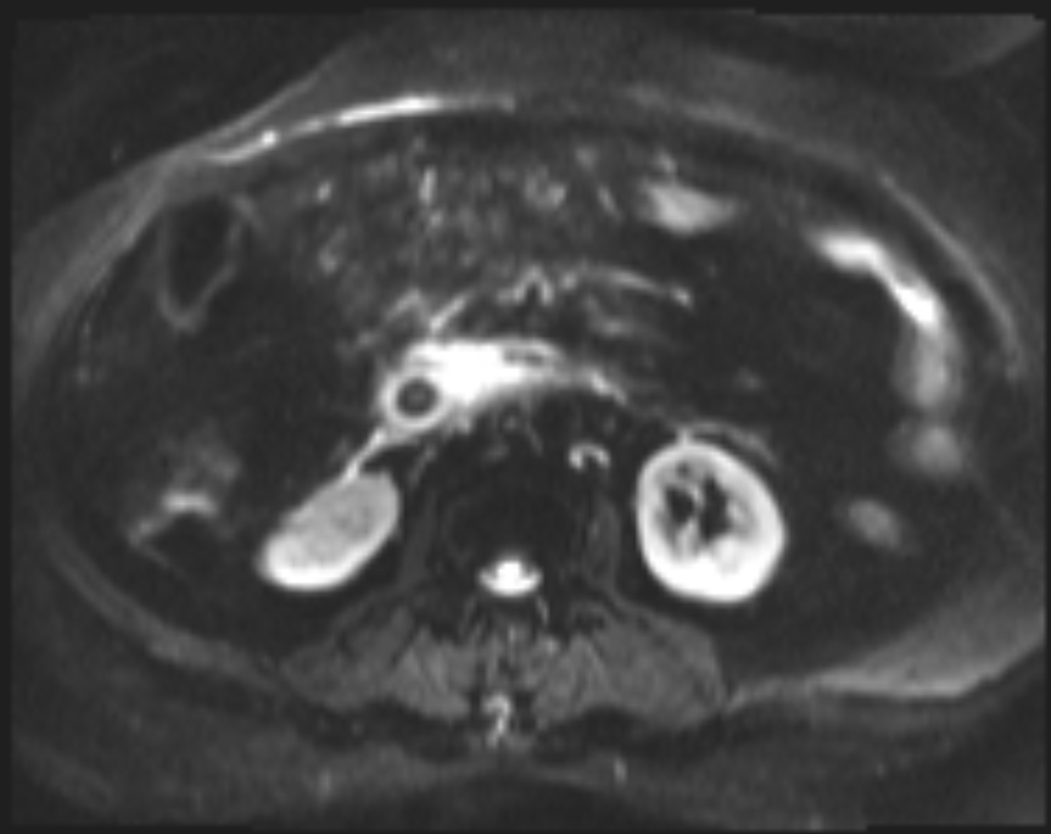 Choledocholithiasis Causing Intrahepatic Biliary Duct Dilation Image