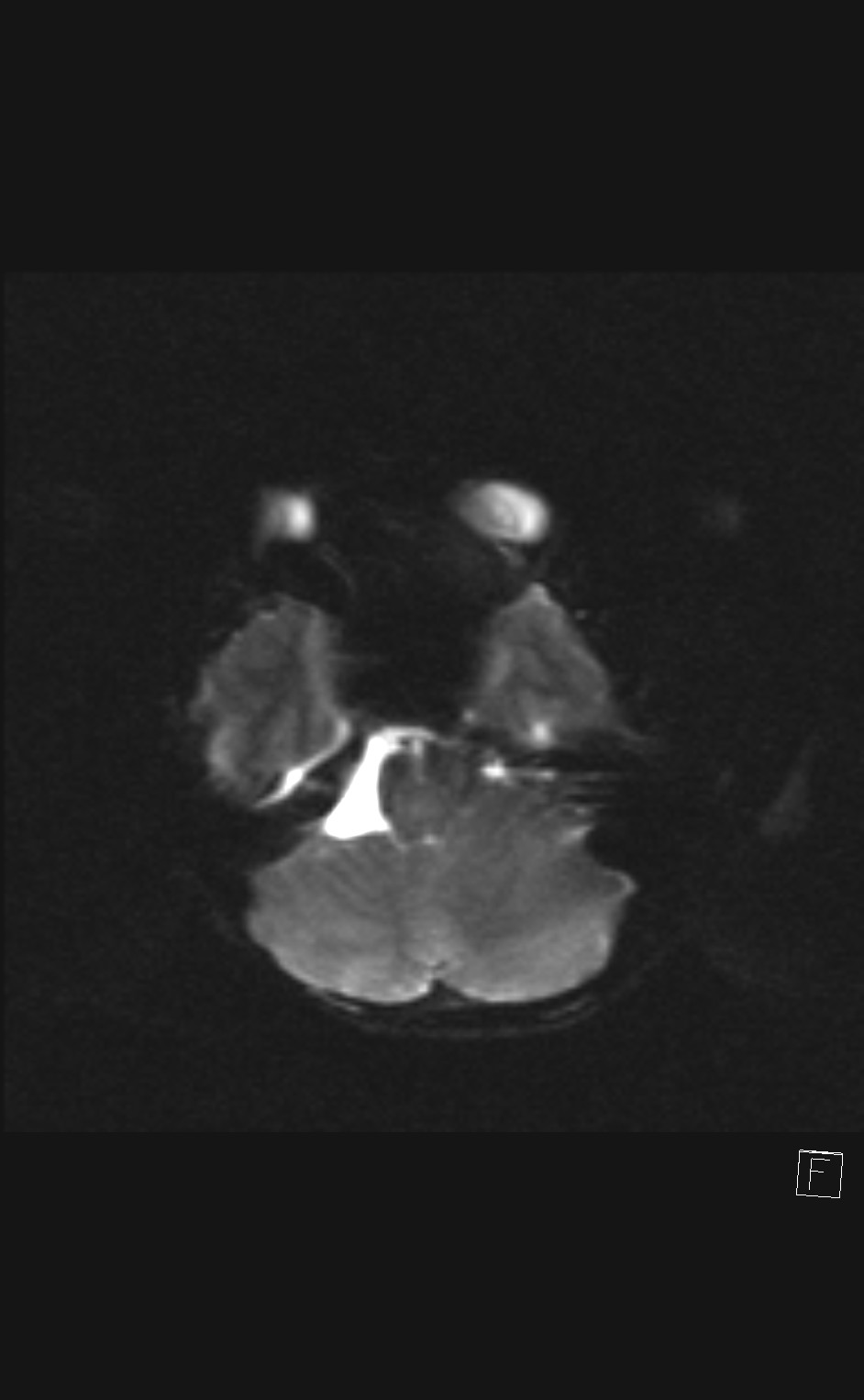 Acquired cerebellar tonsillar ectopia | Image | Radiopaedia.org