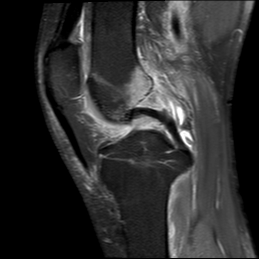 Spontaneous osteonecrosis of the knee | Image | Radiopaedia.org