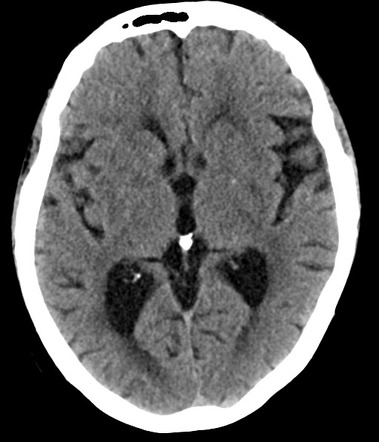 Chronic hypertensive encephalopathy | Radiology Case | Radiopaedia.org