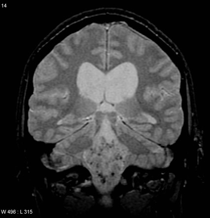 Subependymoma - large and enhancing | Image | Radiopaedia.org