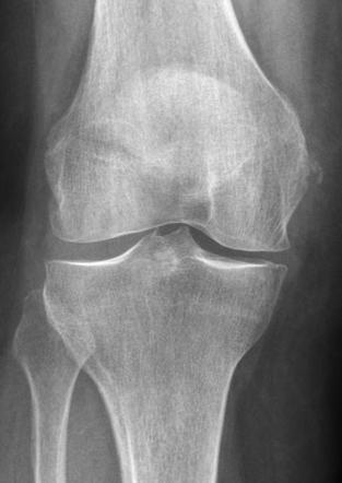 Pellegrini-Stieda lesion | Radiology Case | Radiopaedia.org