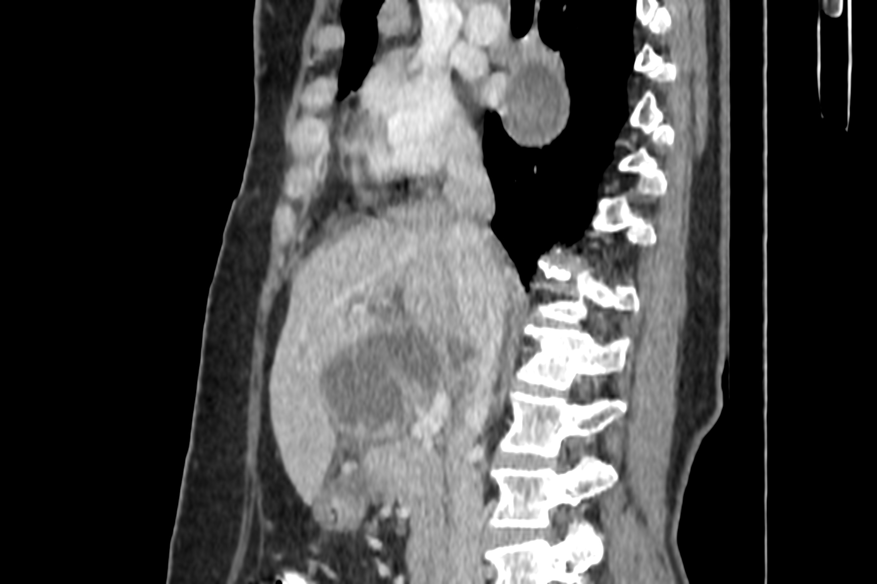 Pseudocyst Of Pancreas With Mediastinal Extension Image