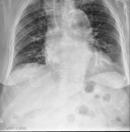 Hepatic Hydatid Infection Radiology Reference Article Radiopaedia Org