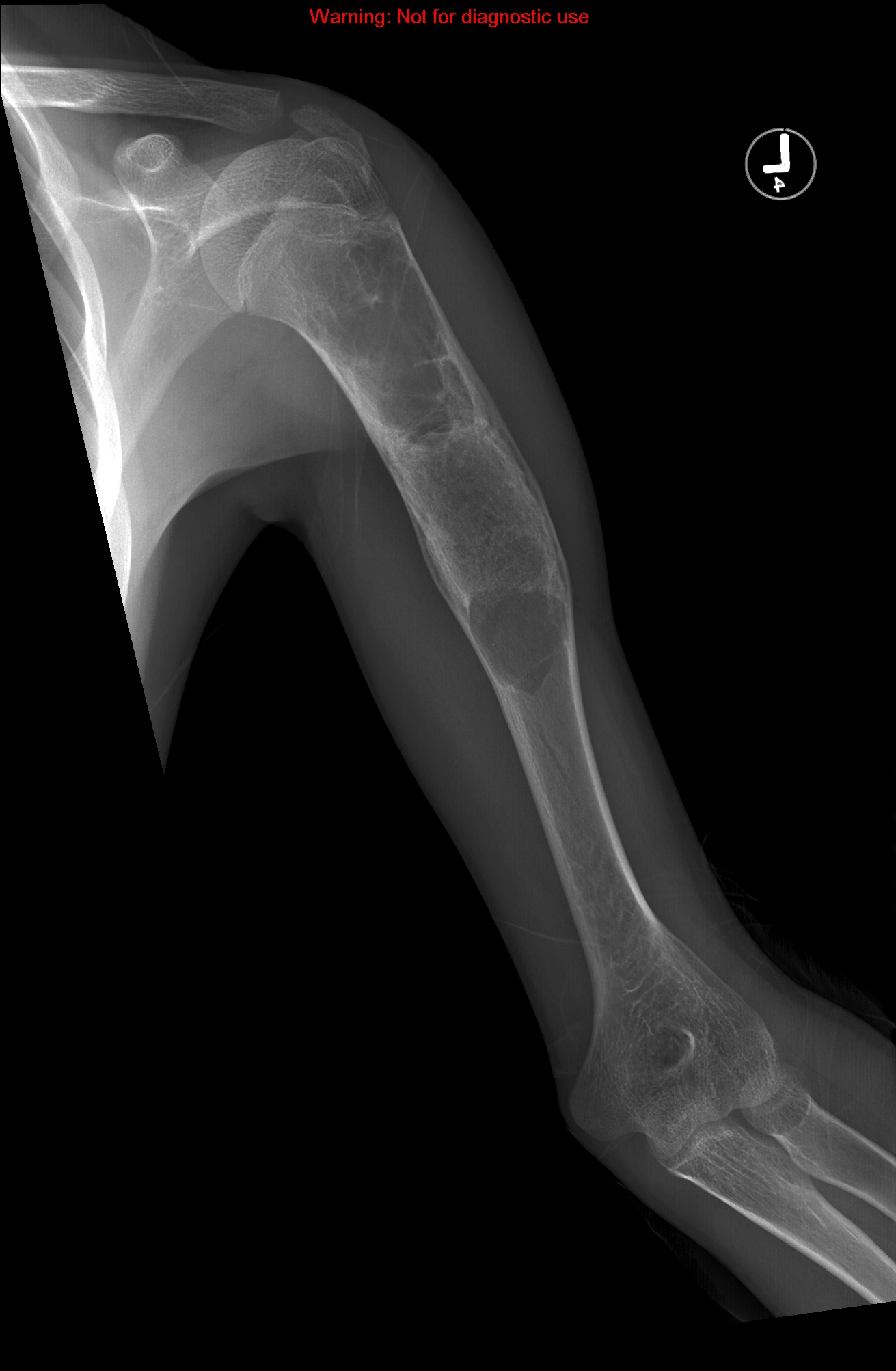 Unicameral bone cyst | Image | Radiopaedia.org