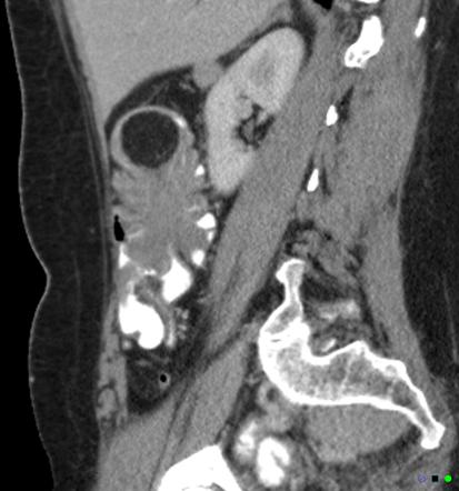 Gastrointestinal Tract Lipomas Radiology Reference Article Radiopaedia Org