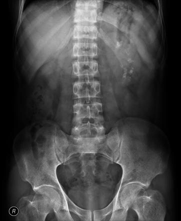 Nephrocalcinosis | Radiology Reference Article | Radiopaedia.org