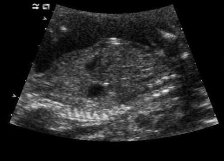 Congenital diaphragmatic hernia | Radiology Case | Radiopaedia.org