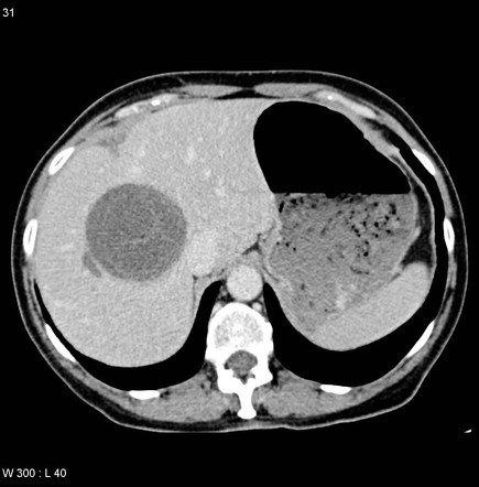 Hepatic Abscess Radiology Reference Article Radiopaedia Org