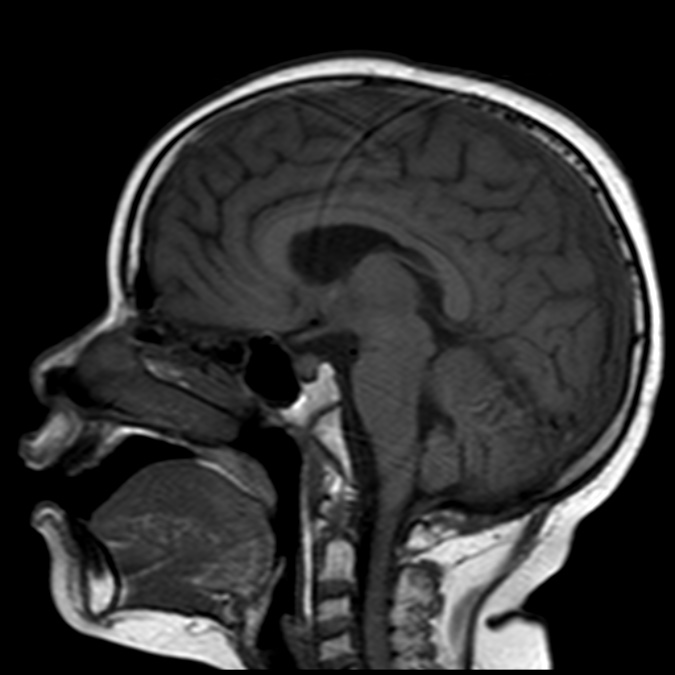 Leukemic meningitis | Image | Radiopaedia.org