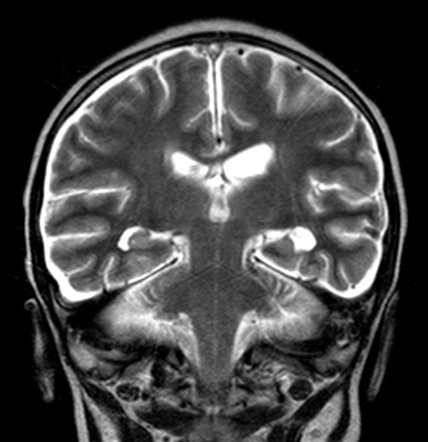 Leukemic meningitis | Image | Radiopaedia.org