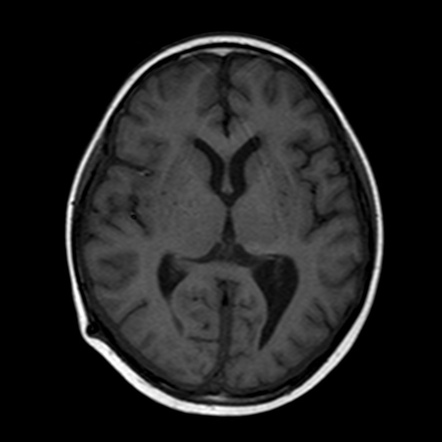 Leukemic meningitis | Image | Radiopaedia.org